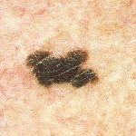 Rak kože: Znakovi za koje morate znati!