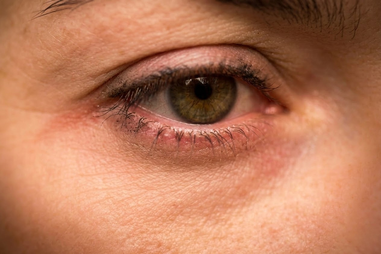 Krupna fotografija oka sa blagim crvenilom na kapku, umornom teksturom i ostacima maskare i ajlajnera na osetljivoj koži.